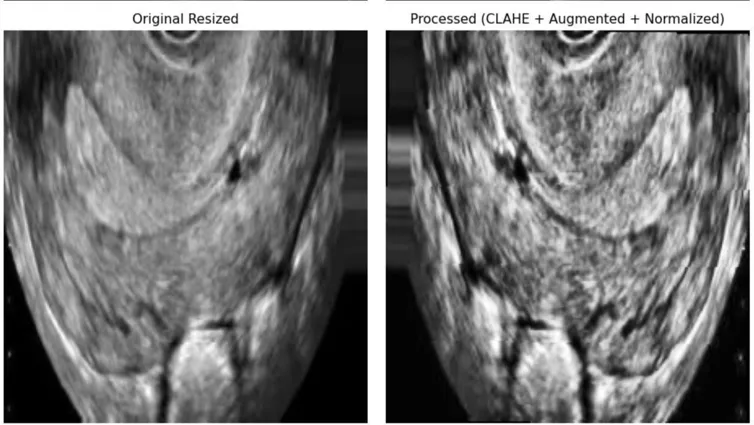 Figure 1: Comparison of Preprocessing Stages in Ultrasound Image Pipeline. Left: Original resized image. Right: Processed image after applying CLAHE, on-the-fly data augmentation, and intensity normalization