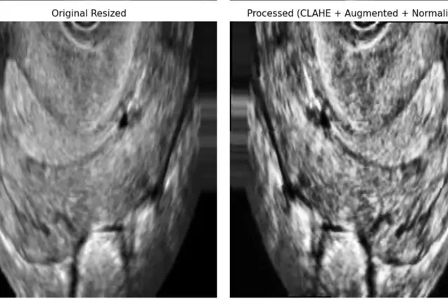 Figure 1: Comparison of Preprocessing Stages in Ultrasound Image Pipeline. Left: Original resized image. Right: Processed image after applying CLAHE, on-the-fly data augmentation, and intensity normalization